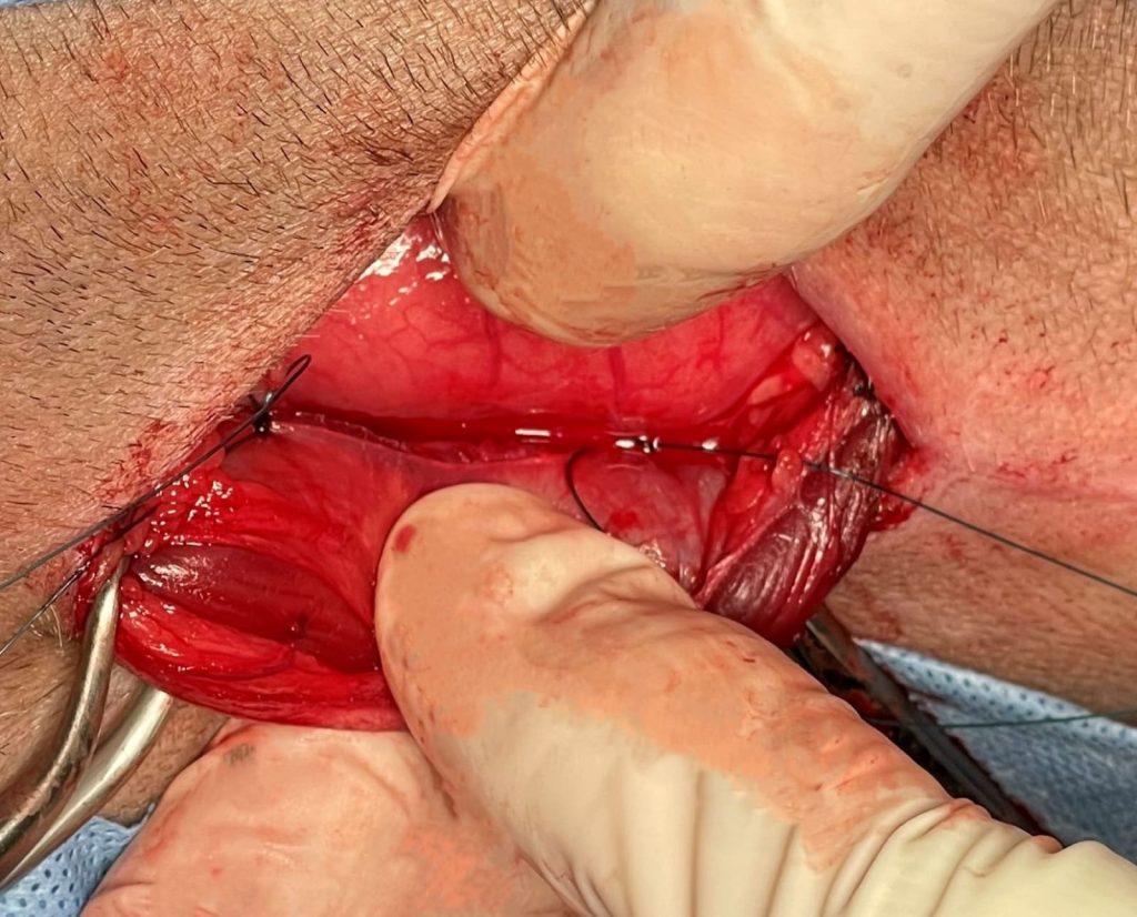 prophylactic gastropexy, or “stomach tacking being performed.